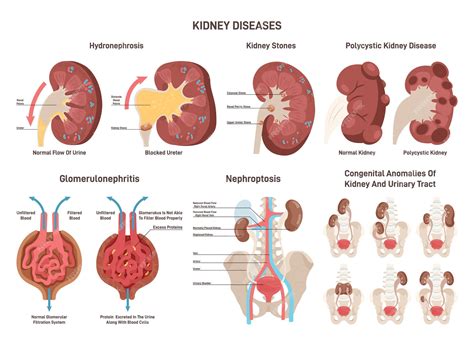 Insuficiencia Renal Aguda Pré Renal