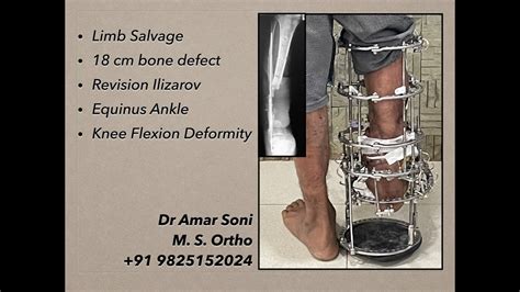 Limb Salvage Revision Ilizarov 18cm Defect Ankle Knee Deformity Youtube