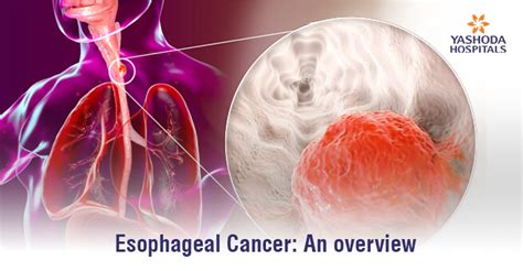 Esophageal Cancer Symptoms Causes Risk Factors Stages Treatment