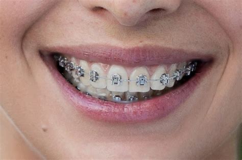 Allerdings können die beschwerden, die du wahrscheinlich damit. Zahnspangen für Erwachsene - Zahnarzt in Würzburg für ...