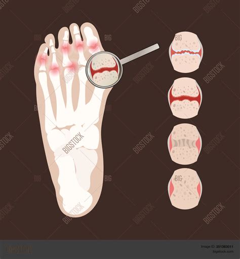 Artritis Leg Vector And Photo Free Trial Bigstock