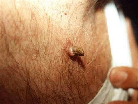 Cutaneous Horn - Pictures, Symptoms, Causes, Removal ...