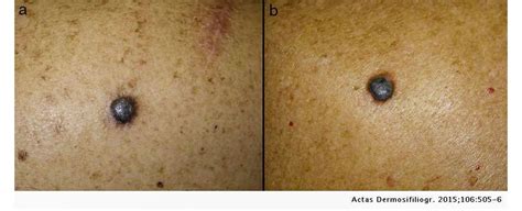 Melanoma Pictures Skin Changes And What To Look For
