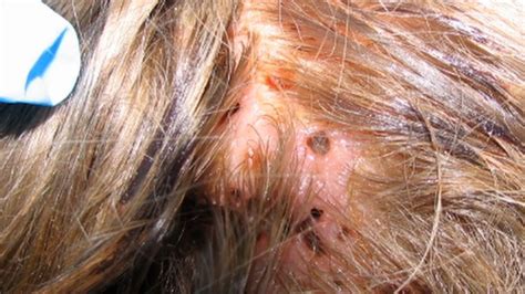 Mysterious Lesions On Girls Head Turn Out To Be Flesh Feasting