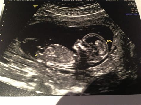 Edited To Add 13 Week Scans Gender Prediction On 16 Week Ultrasound Please