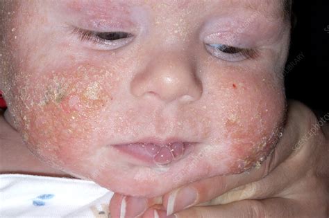 Infected Eczema Stock Image M1500265 Science Photo Library