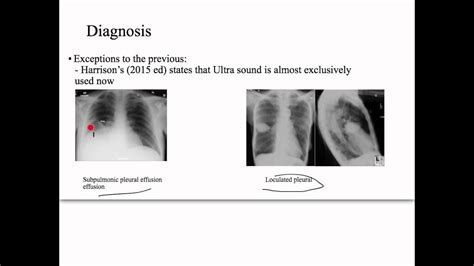 Pleural Effusion Pneumonia