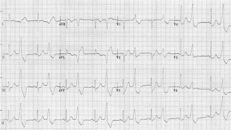 Premature Ventricular Contractions Trigeminy