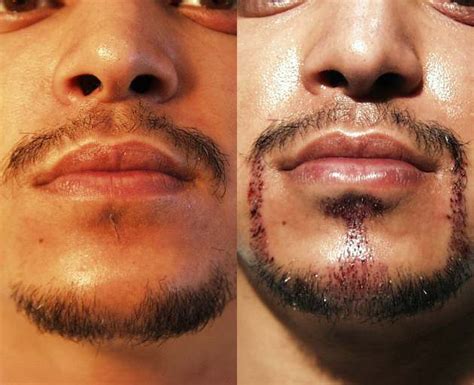 8 minoxidil beard before and afters. Minoxidil beard growth permanent - BeardStylesHQ