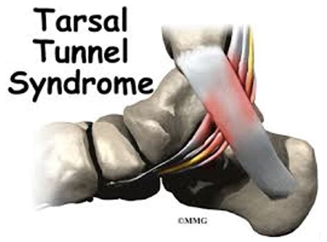 Tarsal Tunnel Syndrome Sports Podiatry