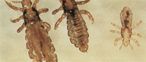 PEDICULOSI | Alloi Cagalli Presta - Studio Dermatologico a ...