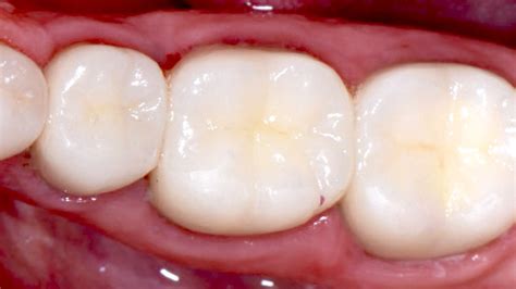 Why Are White Composite Fillings Better Than Silver Amalgam