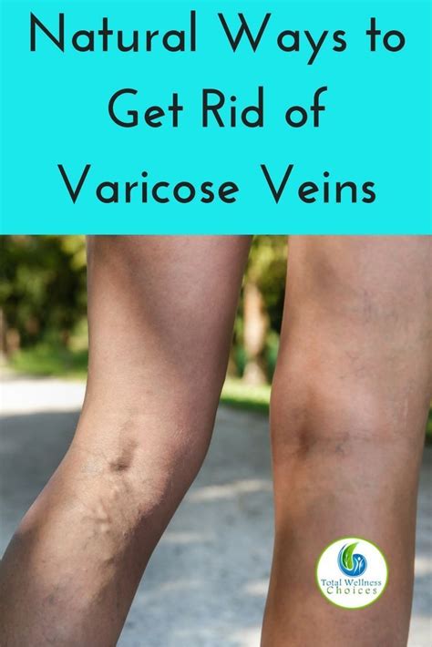 12 Natural Ways To Get Rid Of Varicose Veins Varicose Veins Varicose