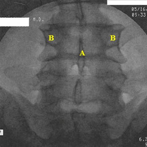 Intraoperative Photograph Of Patient In The Right Lateral Decubitus