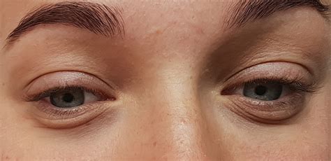 Details More Than 75 Best Treatment For Eye Bags Esthdonghoadian