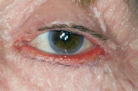 Ectropion Of Eye With Facial Eczema Stock Image C0069184 Science