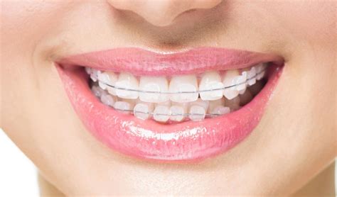 Lingual braces are the most aesthetic type of braces. Can I straighten my teeth without braces? - Australian ...