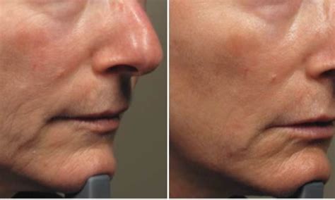 Resurfx Laser Resurfacing The Aesthetic Xpert