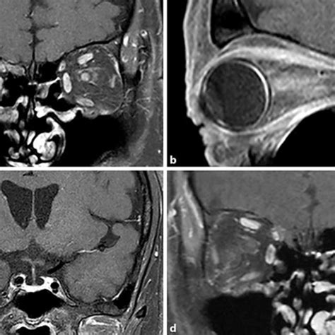 gadolinium enhanced magnetic resonance imaging mri before and after download scientific