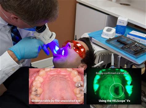 Oral Cancer Screening Key Dental Clinic