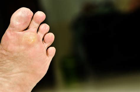 What Do Plantar Warts Look Like