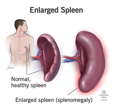 Enlarged Spleen Splenomegaly Symptoms Causes And Treatment