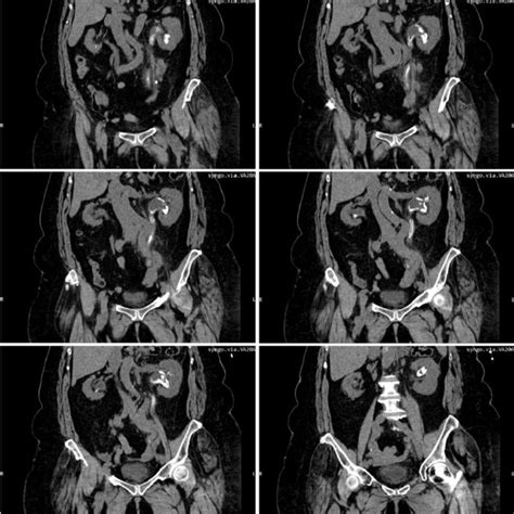 Multiplanar Reconstruction Of Abdominal And Pelvic Ct Scans Without