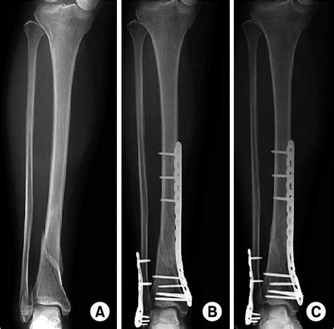A fracture is classified as closed or open. (A) A 32-year-old female with simple fracture of the ...