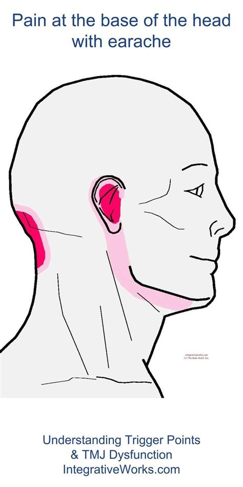 Pin On Tmj Trigger Point Pain