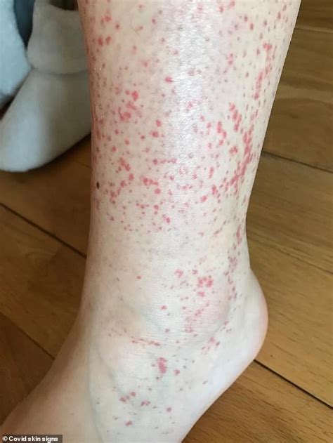 Covid Skin Rashes Are Only Symptom For 21 Patients Says Kcl Study
