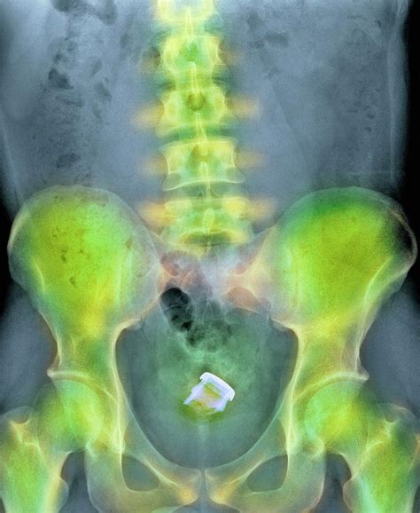 Drinks Bottle In Mans Rectum Photograph By Du Cane Medical Imaging Ltdscience Photo Library