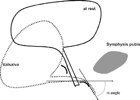 Schematic Illustration Of How Tension Free Vaginal Tape Corrects Stress
