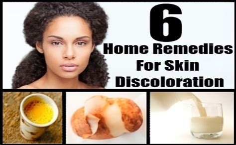 6 Home Remedies For Skin Discoloration And Dark Skin Home Remedies For Skin Skin