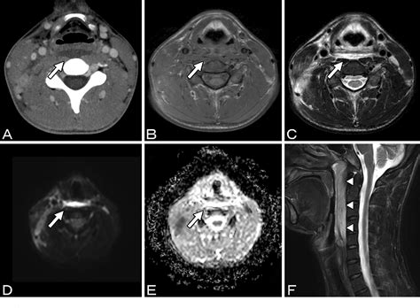 Figure 3 From Adult Recurrence Of Kawasaki Disease Mimicking