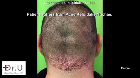 Video Acne Keloidalis Nuchae Removal Surgery For Akn Head Bumps