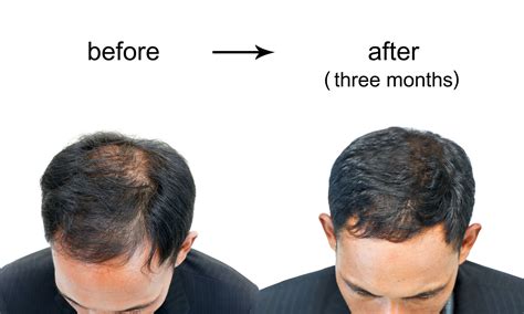 Best Hair Loss Treatments For Men Hair Skin Science