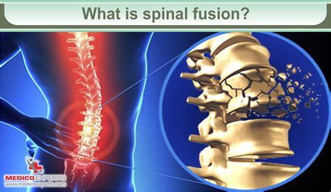 Spinal Fusion Surgery For Back Pain Relief