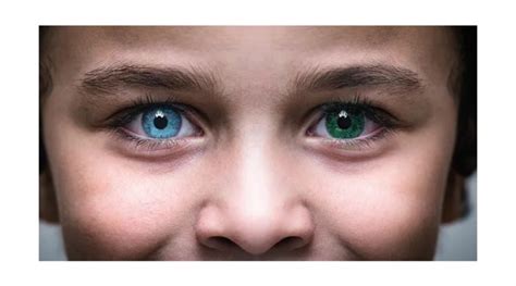 All You Need To Know About Heterochromia Obn