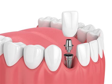 ¿cómo Se Colocan Los Implantes Dentales Zm Centro De Odontología