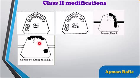 Kennedy Classification Of Partially Edentulous Arches تصنيف انواع