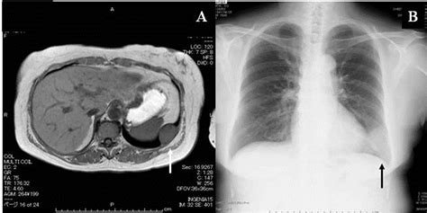Chest Wall Hemangiopericytoma Like Solitary Fibrous Tumor Of The Pleura