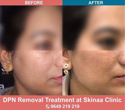 Dpn Removal Service Local Area Rs 400consultation Skinaa Id