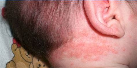 Rash In A Newborn A Description Of Symptoms Types Of Rashes And How