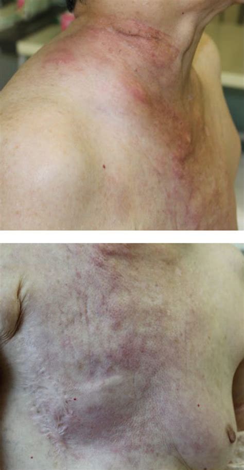 Enlarged Supraclavicular Lymph Nodes Images And Photos Finder