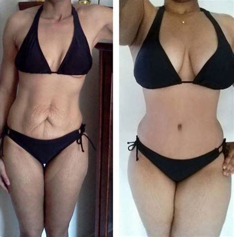 Hernia Photos Before And After Tummy Tuck Veryunlimited