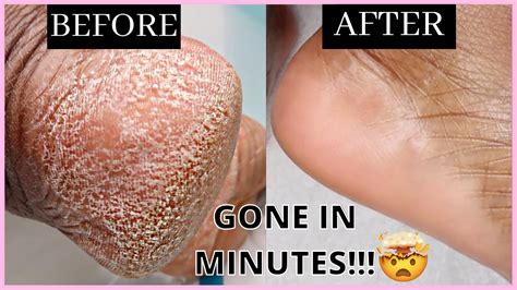 How To Remove Dead Skin Cells From Your Feet In Minutes Self Care Routine Youtube
