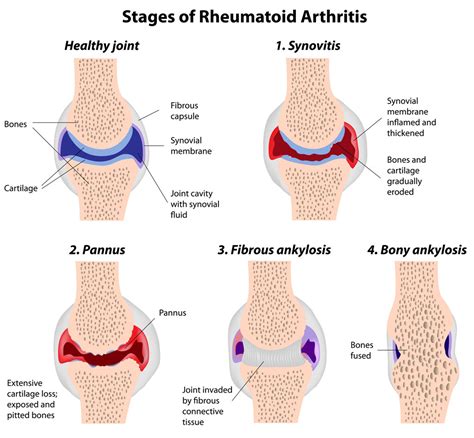 Stages Of Rheumatoid Arthritis Copy