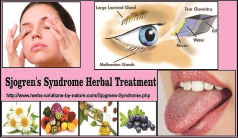 Natural Remedies For Sjogrens Syndrome Dry Eye And Mouth Sjogrens