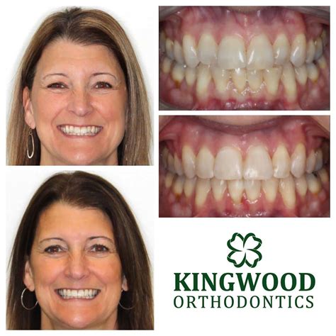 Before And Afters Kingwood Orthodontics