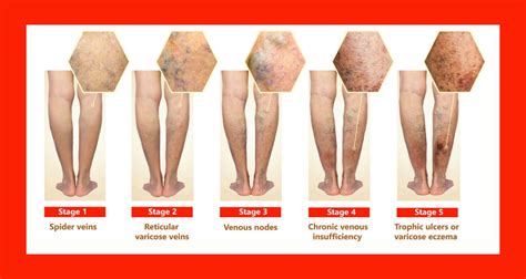Varicose Veins What You Need To Know